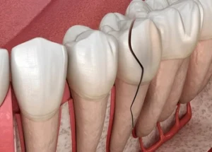 Close view of a fractured front tooth after a sporting impact
