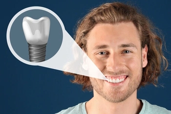 Illustration showing bone grafting to build up the jawbone before an implant