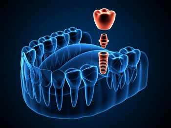 Diagram showing the healing period between a bone graft and dental implant placement