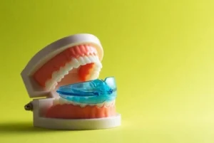 Custom night guard used to protect teeth and gums from grinding