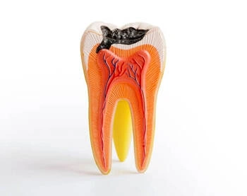 Diagram of a broken tooth with exposed pulp and root after injury