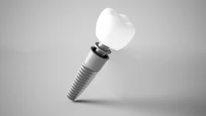 Illustration of a dental implant with its parts labelled