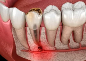 Illustration of a tiny black spot of decay on a lower tooth