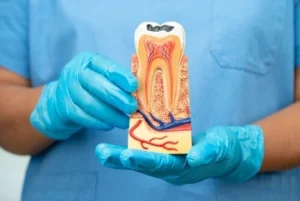 Illustration of a tooth with deep decay reaching the inner pulp