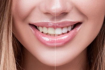 Illustration of tooth shade guide used to assess whitening results