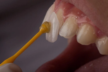 Veneer being bonded to a front tooth during the placement process