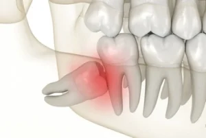 Illustration of an impacted wisdom tooth causing pain